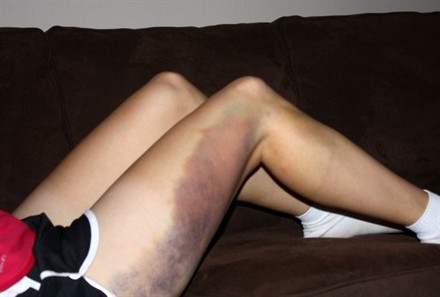 Iliotibial Band Bruising Manual Therapy