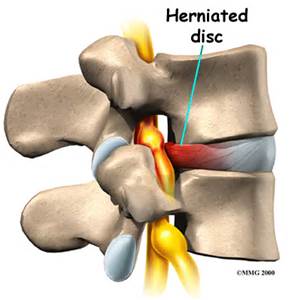 Lumbar Disc Herniation