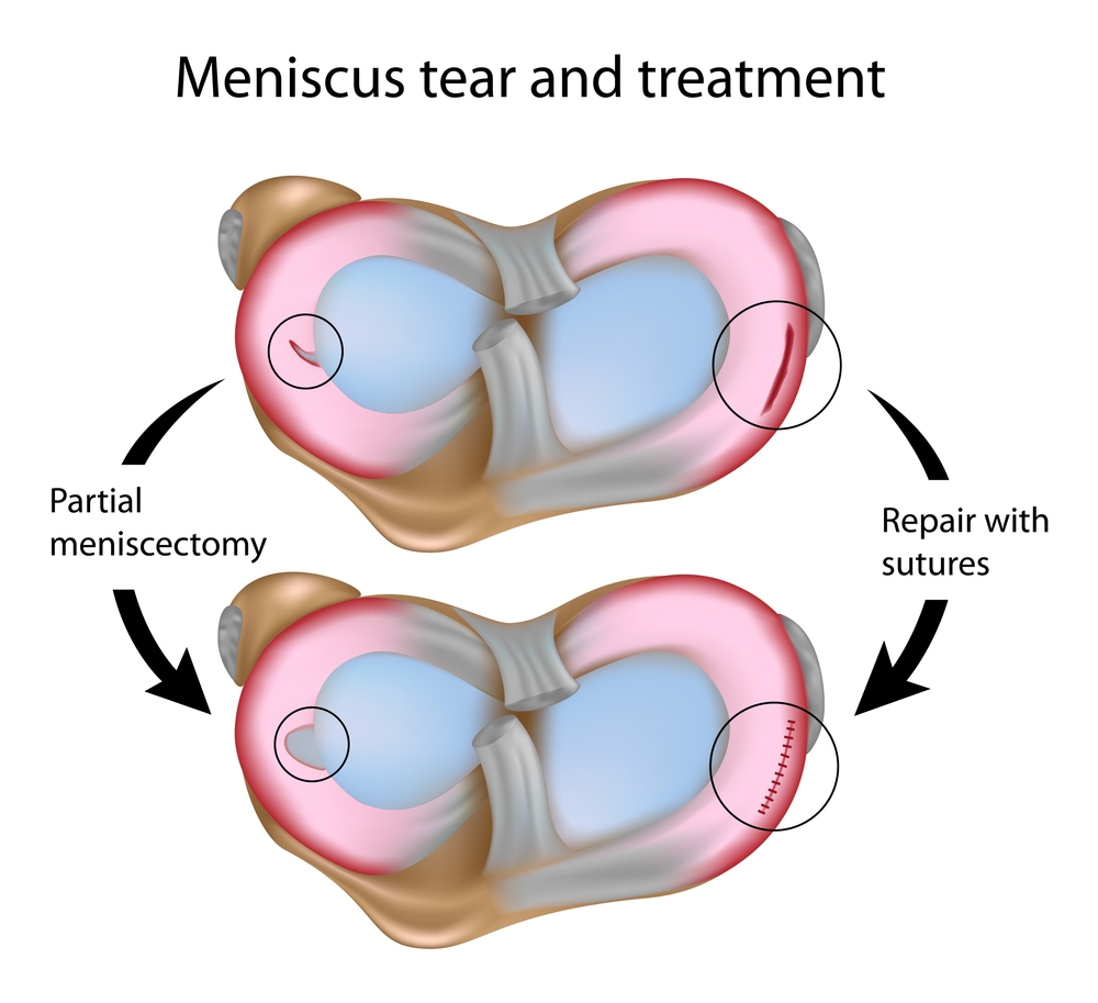 Meniscus Tear And Treatment
