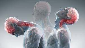 Muscle Injury Whiplash